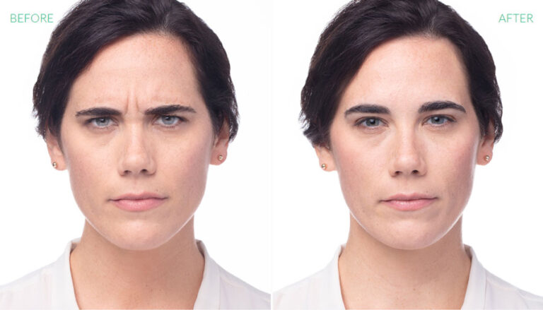 before-after-dysport-1