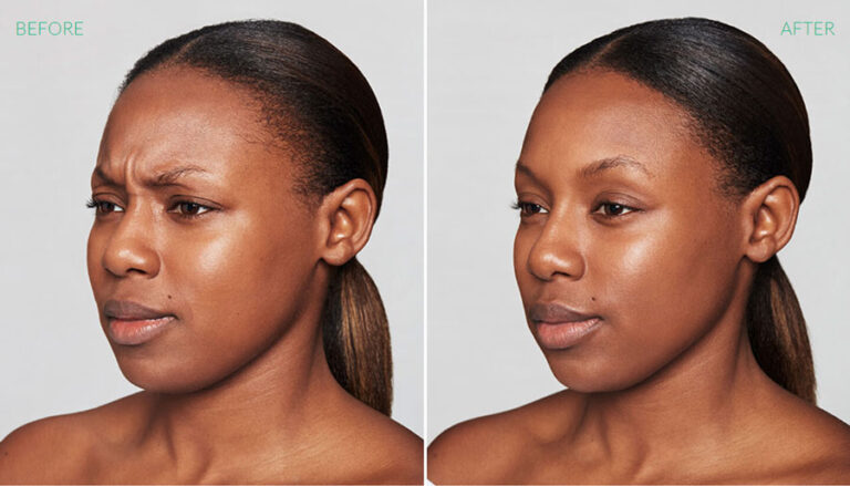 before-after-dysport-2