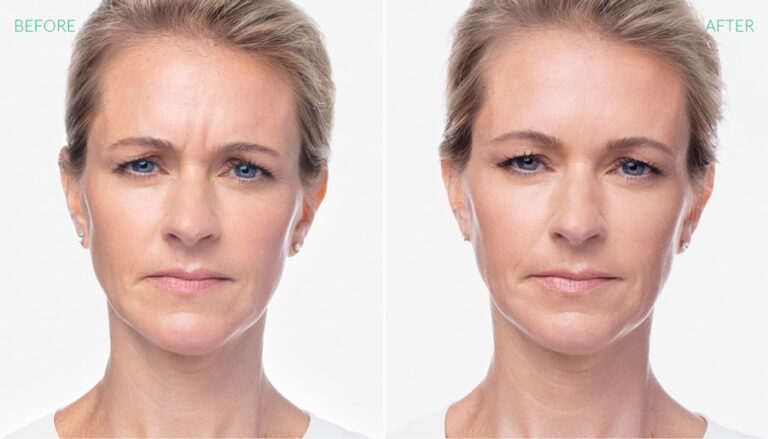 before-after-dysport-3