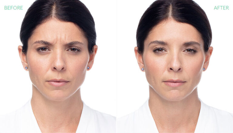 before-after-dysport-4