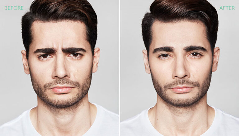 before-after-dysport-5