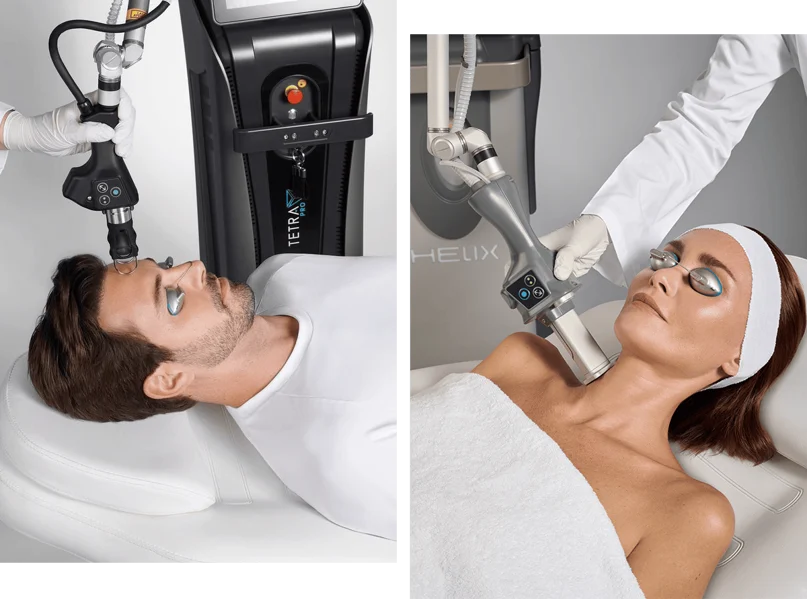 Tetra Coolpeel treatment